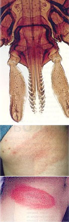 Borreliose