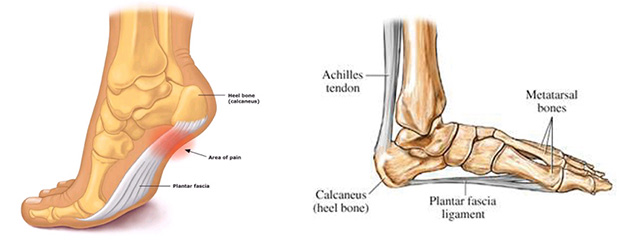 Fasziitis plantaris