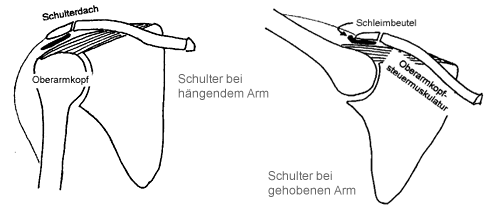 Impingment Syndrom