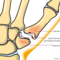 Rhizarthrose