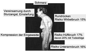 Mögliche Folgen von Osteoporose